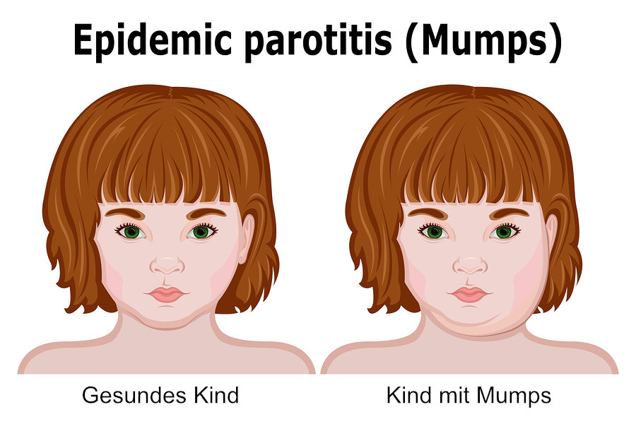 Kinderkrankheit Mumps
